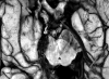 Arteriovenous malformation, midbrain (cerebral peduncle)